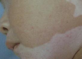 白癜风图片 白癜风图片