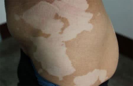 白癜风图片 白癜风图片