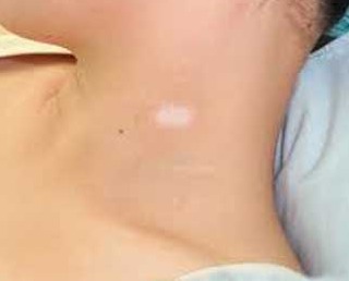 白癜风图片 白癜风图片