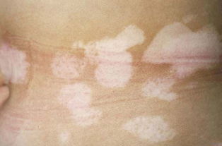 白癜风图片 白癜风图片