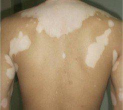 白癜风图片 白癜风图片