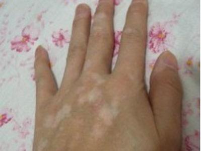 白癜风图片 白癜风图片